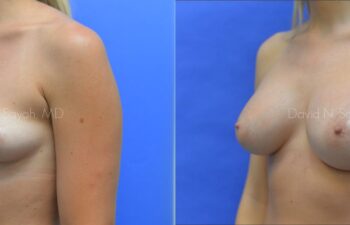 Breast Augmentation Before and After | Sayah Institute