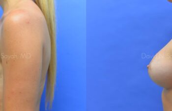 Breast Augmentation Before and After | Sayah Institute