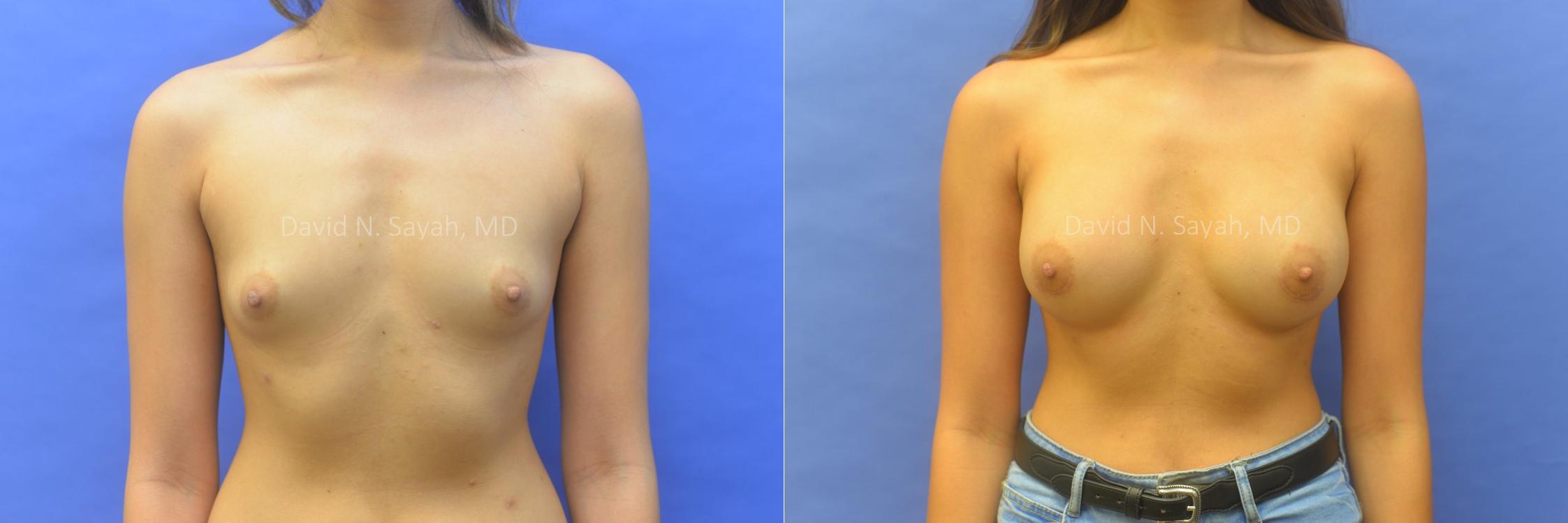 Breast Augmentation Before and After | Sayah Institute