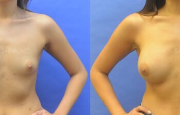 Breast Augmentation Before and After | Sayah Institute