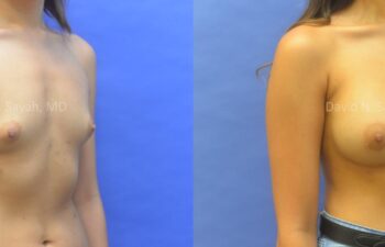 Breast Augmentation Before and After | Sayah Institute