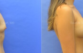 Breast Augmentation Before and After | Sayah Institute