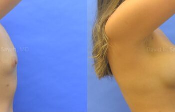 Breast Augmentation Before and After | Sayah Institute