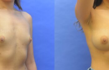 Breast Augmentation Before and After | Sayah Institute