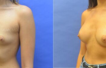 Breast Augmentation Before and After | Sayah Institute