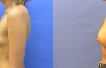 Breast Augmentation Before and After | Sayah Institute
