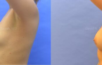 Breast Augmentation Before and After | Sayah Institute