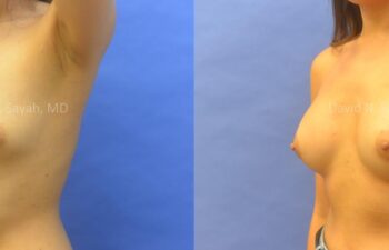 Breast Augmentation Before and After | Sayah Institute