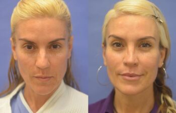 Rhinoplasty Before and After | Sayah Institute