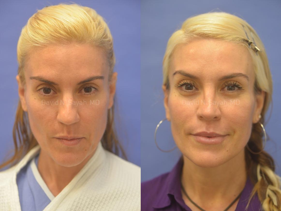 Rhinoplasty Before and After | Sayah Institute