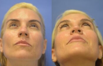 Rhinoplasty Before and After | Sayah Institute
