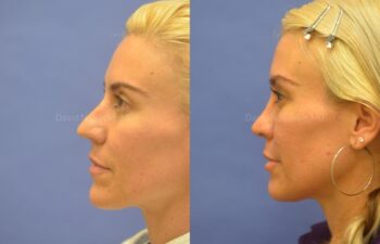 Rhinoplasty Before and After | Sayah Institute