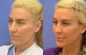 Rhinoplasty Before and After | Sayah Institute