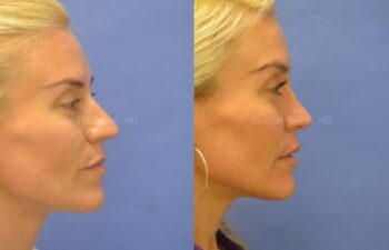 Rhinoplasty Before and After | Sayah Institute