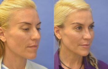 Rhinoplasty Before and After | Sayah Institute