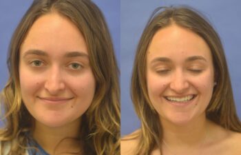 Rhinoplasty Before and After | Sayah Institute