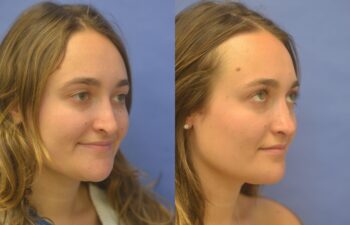 Rhinoplasty Before and After | Sayah Institute