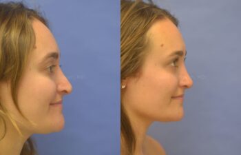 Rhinoplasty Before and After | Sayah Institute