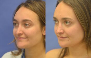 Rhinoplasty Before and After | Sayah Institute