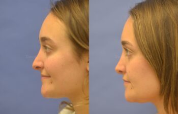 Rhinoplasty Before and After | Sayah Institute
