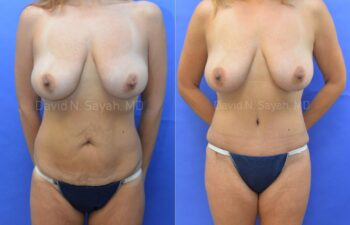 Tummy Tuck Before and After | Sayah Institute