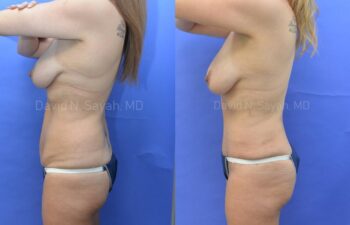 Tummy Tuck Before and After | Sayah Institute