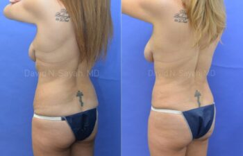 Tummy Tuck Before and After | Sayah Institute