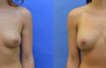 Breast Augmentation Before and After | Sayah Institute