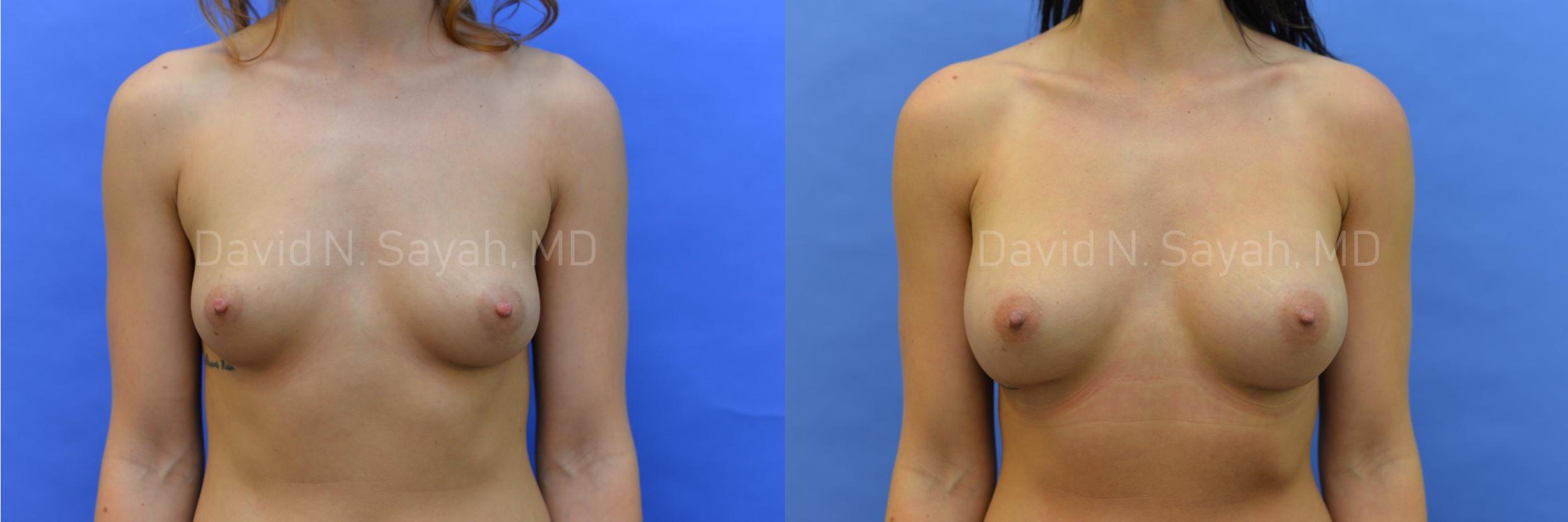 Breast Augmentation Before and After | Sayah Institute