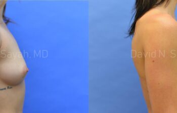 Breast Augmentation Before and After | Sayah Institute