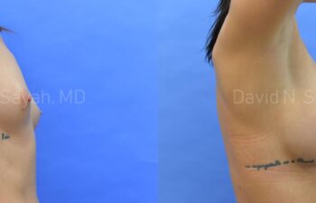 Breast Augmentation Before and After | Sayah Institute
