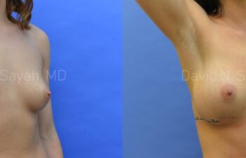 Breast Augmentation Before and After | Sayah Institute