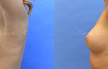 Breast Augmentation Before and After | Sayah Institute