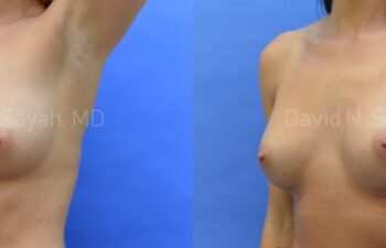 Breast Augmentation Before and After | Sayah Institute