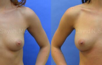 Breast Augmentation Before and After | Sayah Institute
