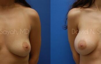 Breast Augmentation Before and After | Sayah Institute
