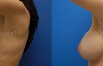 Breast Augmentation Before and After | Sayah Institute