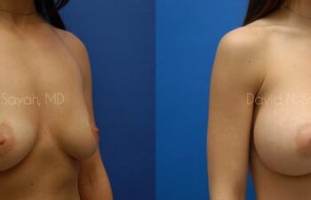 Breast Augmentation Before and After | Sayah Institute