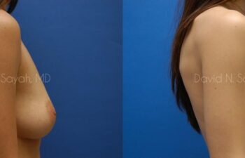 Breast Augmentation Before and After | Sayah Institute