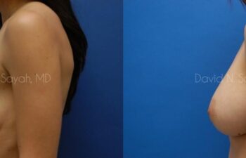 Breast Augmentation Before and After | Sayah Institute