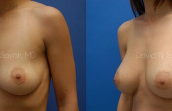 Breast Augmentation Before and After | Sayah Institute