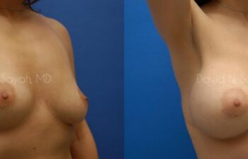 Breast Augmentation Before and After | Sayah Institute