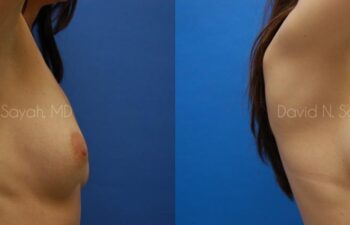 Breast Augmentation Before and After | Sayah Institute