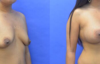 Breast Augmentation Before and After | Sayah Institute