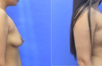 Breast Augmentation Before and After | Sayah Institute