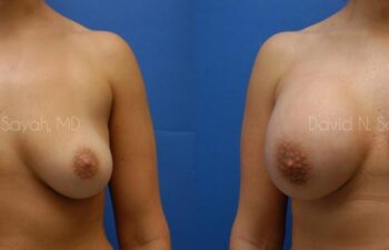 Breast Augmentation Before and After | Sayah Institute