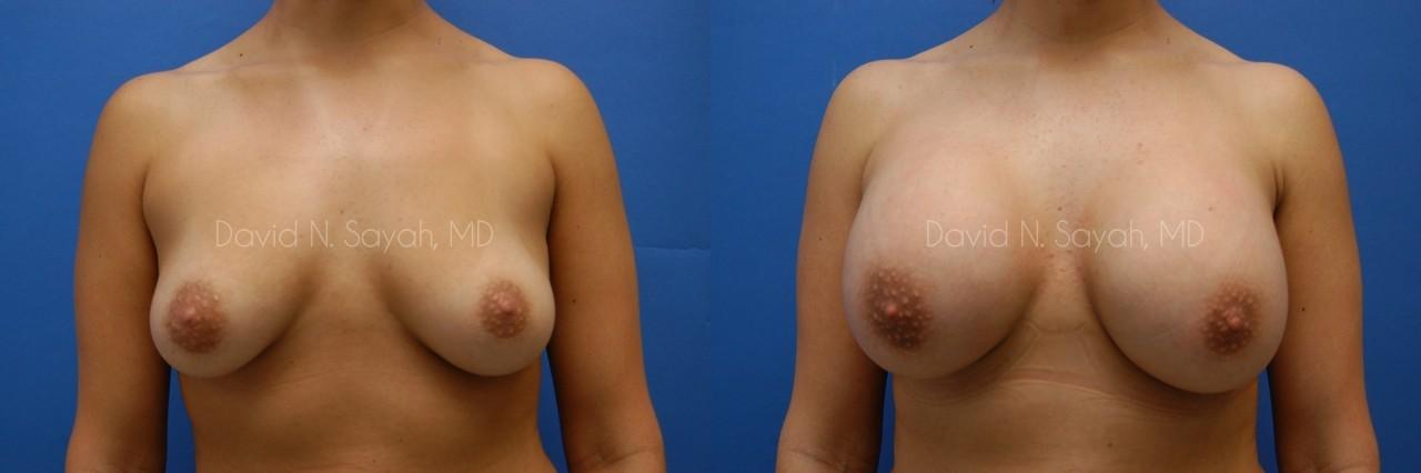 Breast Augmentation Before and After | Sayah Institute