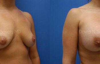 Breast Augmentation Before and After | Sayah Institute