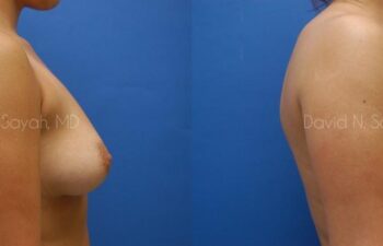 Breast Augmentation Before and After | Sayah Institute