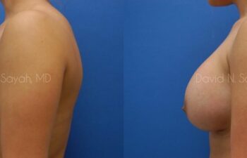 Breast Augmentation Before and After | Sayah Institute